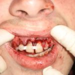 splinted_teeth