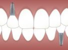 Missing Teeth? Could Dental Implants Be Right for You?